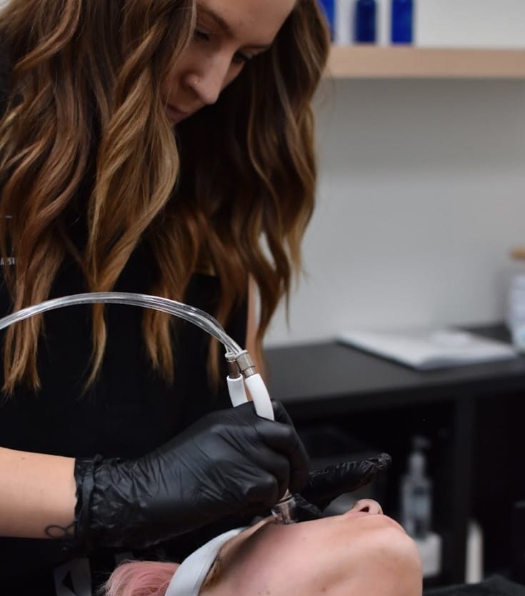 Microneedling treatment